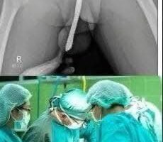 😱Girl was hospitalized for trying one more pen…See more