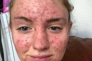 She Thought It Was Just an Allergy—The Truth Was Far More Serious