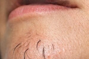 Why Chin Hair Grows in Women and What It May Indicate