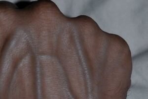 Why Veins May Look More Visible Sometimes
