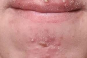 Been dating this woman I met at Walmart and after finally getting some I woke up with these on my face what is this?