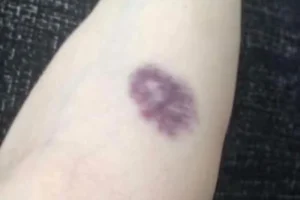 BE CAREFUL, if you get these bruises on your body, it means you have Ca…see more