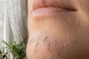 What Chin Hair in Women Really Says About Horm:ones