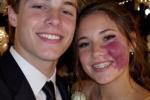 Only One Boy Asked Me to Prom Because No One Else Wanted to Due to the Birthmark on My Face – Everyone Laughed Until an Officer Walked Into the Hall