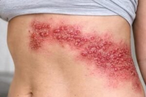 Why Acne Appears on These 8 Body Areas, and What You Should Do