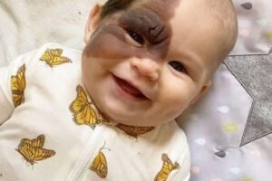 Parents’ Love Drives Them to Remove Daughter’s Birthmark