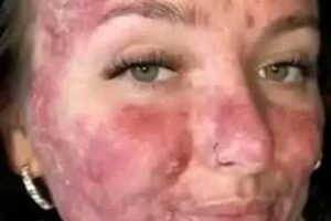 I’m here to give an alert, – I thought it was an allergy but I was diagnosed with can…. See more