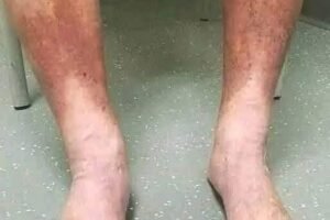 SILENT KILLER OR HARMLESS PUFFINESS? WHY YOUR SWOLLEN FEET ARE SCREAMING FOR YOUR ATTENTION