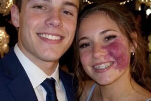 Only one boy asked me to prom because no one else wanted to go with me because of the birthmark on my face — everyone laughed until police officers walked into the gym.