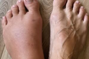 If your feet swell, it is a clear sign that…