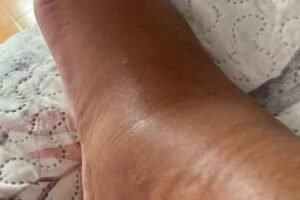 If your feet swell, it is a clear sign that…