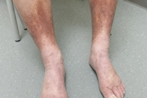 Persistent Leg Swelling and Skin Darkening: When to See a Doctor