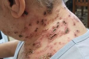 Shingles: The Silent Disease You Should Know About