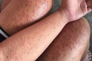 Skin Rash With Breathing Trouble? It Could Be a Life-Threatening Allergic Reaction